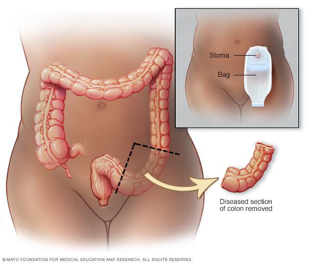 Colon cancer | Altru Health System